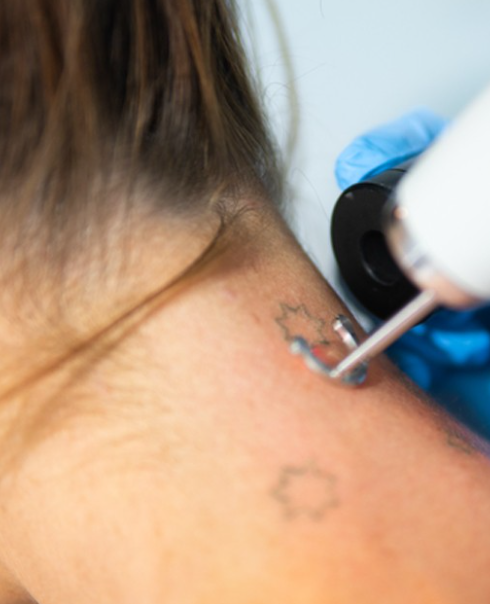 Your Guide to Premier Tattoo Removal Services in Sydney